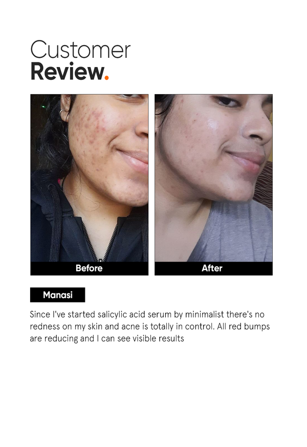 Salicylic Acid 2% Face Serum