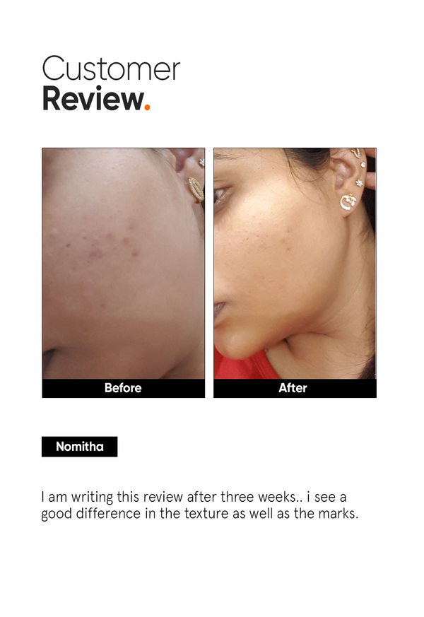 AHA PHA BHA 32% Face Peel